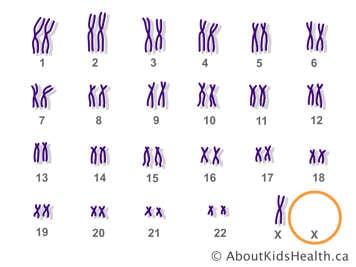 Chromosomes in a female with one copy of the X chromosome missing