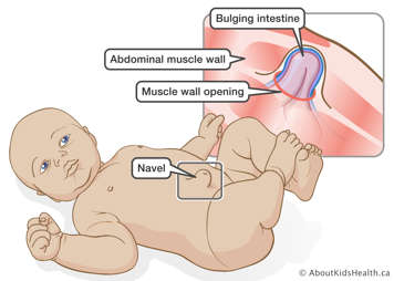 Intestine bulging through muscle wall opening in baby&rsquo;s abdomen