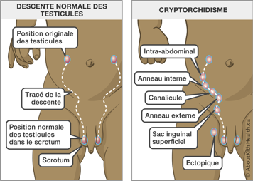 Tracé de la descente normale des testicules et le tracé et les possibles emplacements des testicules non descendus