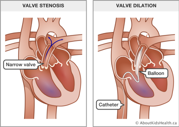 Heart with narrow valve and heart with catheter and balloon through blood vessel and valve