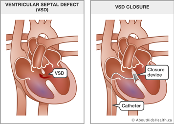 Heart with ventricular septal defect and heart with catheter and closure device inserted into VSD