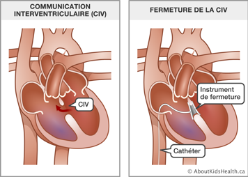 Un cœur avec communication interventriculaire et un cœur avec un cathéter et un instrument de fermeture insérés dans la CIV