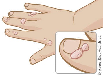 A hand with warts on the fingers and a close-up of warts around the fingernail