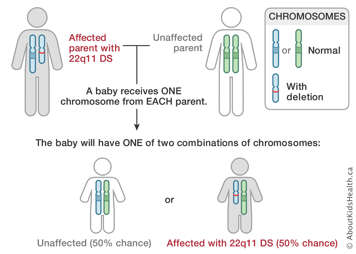 Chromosome distribution from an affected parent with 22q11 DS and an unaffected parent, producing two possible combinations