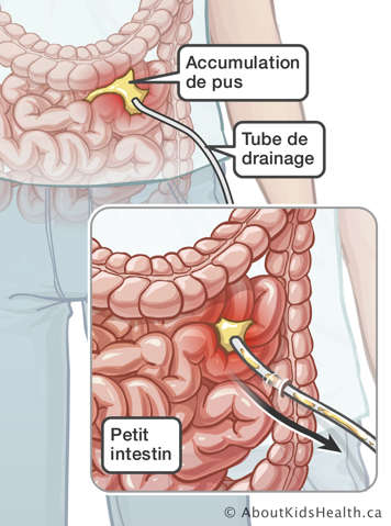 Accumulation de pus et tube de drainage dans l’intestin grêle