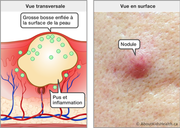 Vue transversale de la peau avec du pus et d’inflammation et une grosse bosse enflée, et la vue en surface d’une nodule