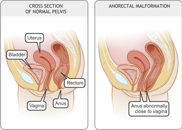 Cross-section of normal pelvis in a girl and cross-section of pelvis with anus abnormally close to vagina