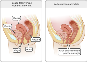 Coupe transversales d’un bassin normal féminin et d’un bassin avec l’anus anormalement proche du vagin