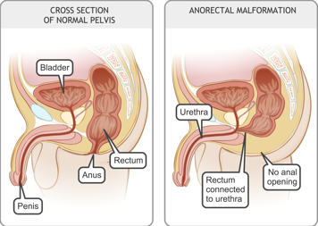 Cross-section of normal pelvis in a boy and cross-section of pelvis with rectum connected to urethra and no anal opening