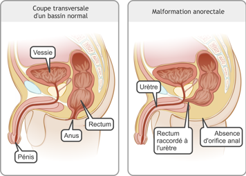 Coupes transversales d’un bassin normal mâle et d’un bassin avec l’absence d’orifice anal et le rectum raccordé à l’urètre