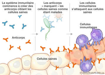 Les anticorps marquent les cellules saines come étant malades, les cellules immunitaires s’attaquent aux cellules saines