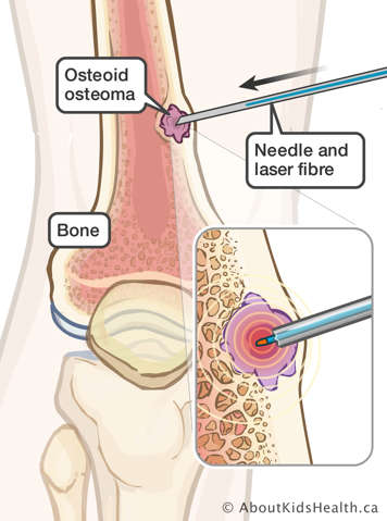 Illustration of bone with needle and laser fibre inserted into osteoid osteoma