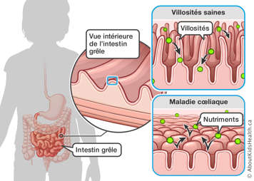 Vue de l’emplacement de l’intestin grêle avec un parallèle entre des villosités saines et des villosités aplaties qui apparaissent habituellement avec la maladie cœliaque
