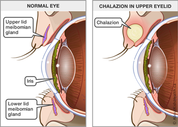 Upper and lower lid melbomian glands in a normal eye and an eye with a chalazion in the upper eyelid