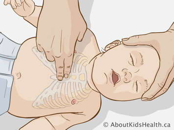 Posicionando a un bebé para realizarle compresiones torácicas para la reanimación cardiopulmonar