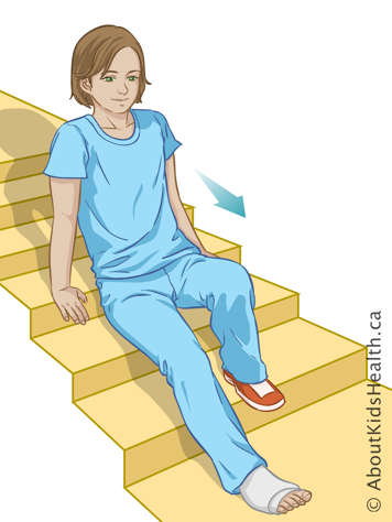 Child scooting down stairs on their bottom, using both arms and the unaffected leg