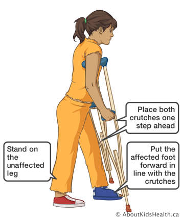 Walking on affected leg by placing both crushes one step ahead and putting the affected foot forward in line with crutches