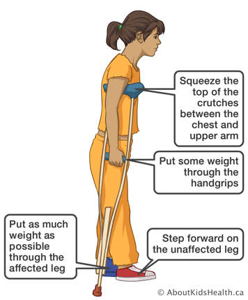 Using crutches to step forward on the unaffected leg while putting as much weight as possible through the affected leg