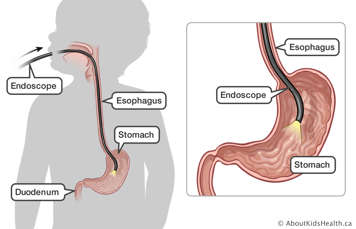 The esophagus, stomach and duodenum are identified with endoscope inserted through the mouth and esophagus into the stomach