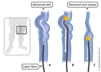 Laser fibre inserted into abnormal vein in the leg and then turned on as it’s pulled back out to close the vein