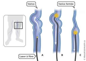 Un laser à fibre inséré dans une varice dans la jambe et puis activé en retirant le laser pour fermer la varice