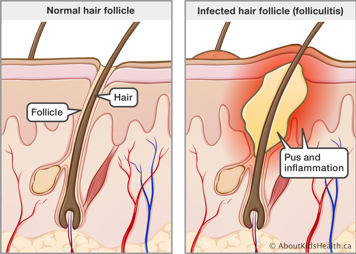 Cross section of skin with normal hair follicle and cross section of skin with infected hair follicle (folliculitis)