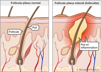 Coupe transversal de la peau avec follicule pileux normal et coupe transversal de la peau avec follicule pileux infecté
