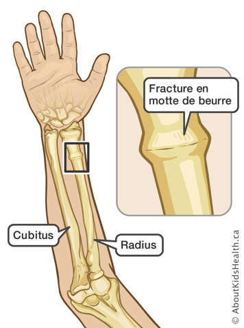 Illustration d’un bras avec une fracture en motte de beurre du radius