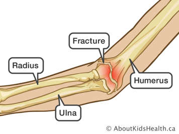 Arm with a fractured humerus