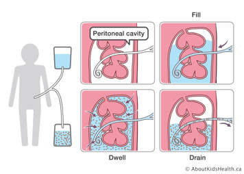 Medical illustration of catheter in peritoneal cavity, which fills the cavity with solution, and then the solution is drained
