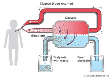 Blood travelling out the body into the dialyzer to be cleaned and then travelling back into the body