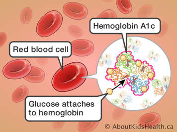 Glucose attaching to Hemoglobin A1c in red blood cells