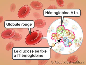 Le glucose se fixant à l’Hémoglobine A1c dans les globules rouges