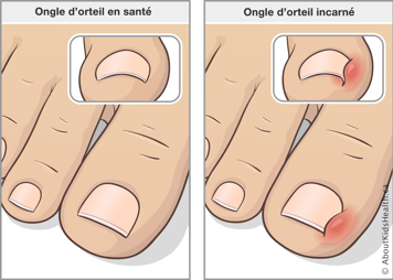 Illustration d’un ongle d’orteil en santé et d’un ongle d’orteil incarné