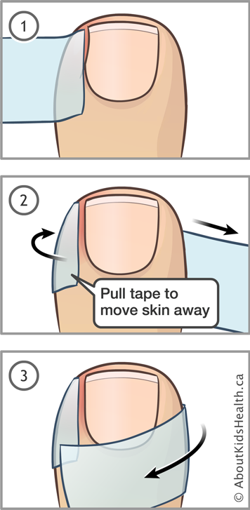Attaching tape to skin beside toenail, pulling to move skin away from toenail, then wrapping tape around to attach the ends