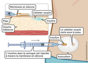 Un cathéter souple sous la peau avec une membrane en silicone à l’extérieur pour injecter l’insuline à l’aide d’une seringue