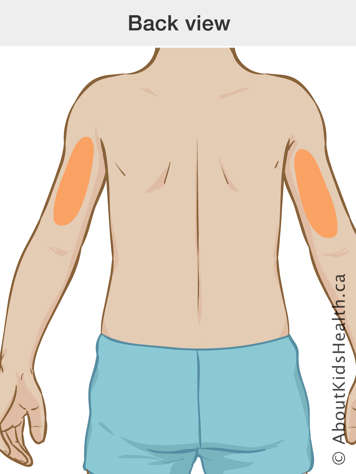 Markings on backs of upper arms indicating insulin injection sites