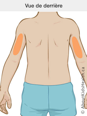 Vue de derrière des sites d’injection d’insuline sur l’arrière des bras