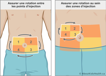 Assurer une rotation entre les quatre points d’injection sur l’abdomen et puis une rotation au sein des zones d’injection