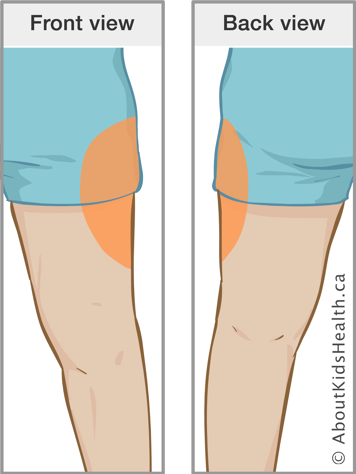 Front view and back view of marking on thigh indicating insulin injection site