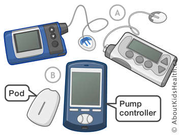 Insulin pumps with plastic tubing and an insulin pump without tubing, but with a pod and pump controller