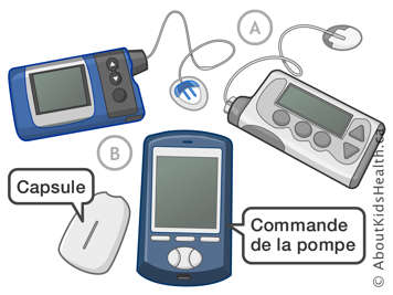 Des pompes à insuline avec tube en plastique et une pompe à insuline sans tube, mais avec capsule et commande de la pompe