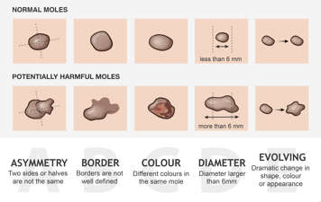 Check moles for asymmetry, undefined borders, different colours, diameter larger than 6mm, and evolving appearance