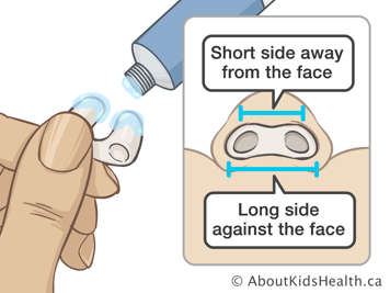 Applying jelly to nasal stent to insert it with short side away from the face and long side against the face