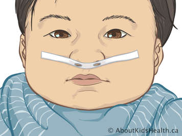 Baby with tape under the nose and across cheeks with a hole in the tape for each nostril