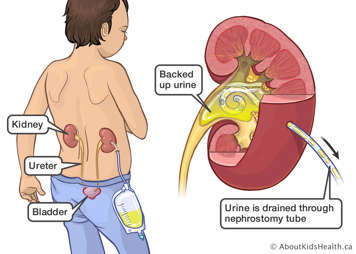 Illustration of backed up urine in the kidney draining through a nephrostomy tube