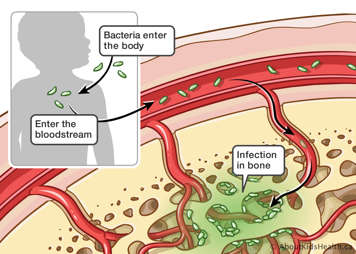 Illustration of bacteria entering the body, then entering the bloodstream and causing an infection in the bone