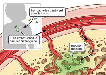 Illustration des bactéries pénétrant dans le corps, entrant dans la circulation sanguine et causant une infection osseuse