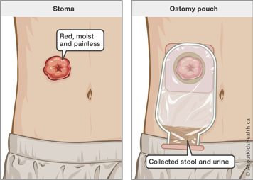 Abdomen with a red, moist and painless stoma and an abdomen with an ostomy pouch over stoma collecting stool and urine