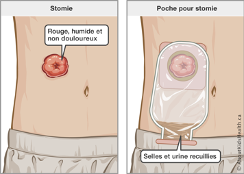 Stomie rouge, humide et non douloureux sur l’abdomen et une stomie avec une poche attachée pour les selles et l’urine